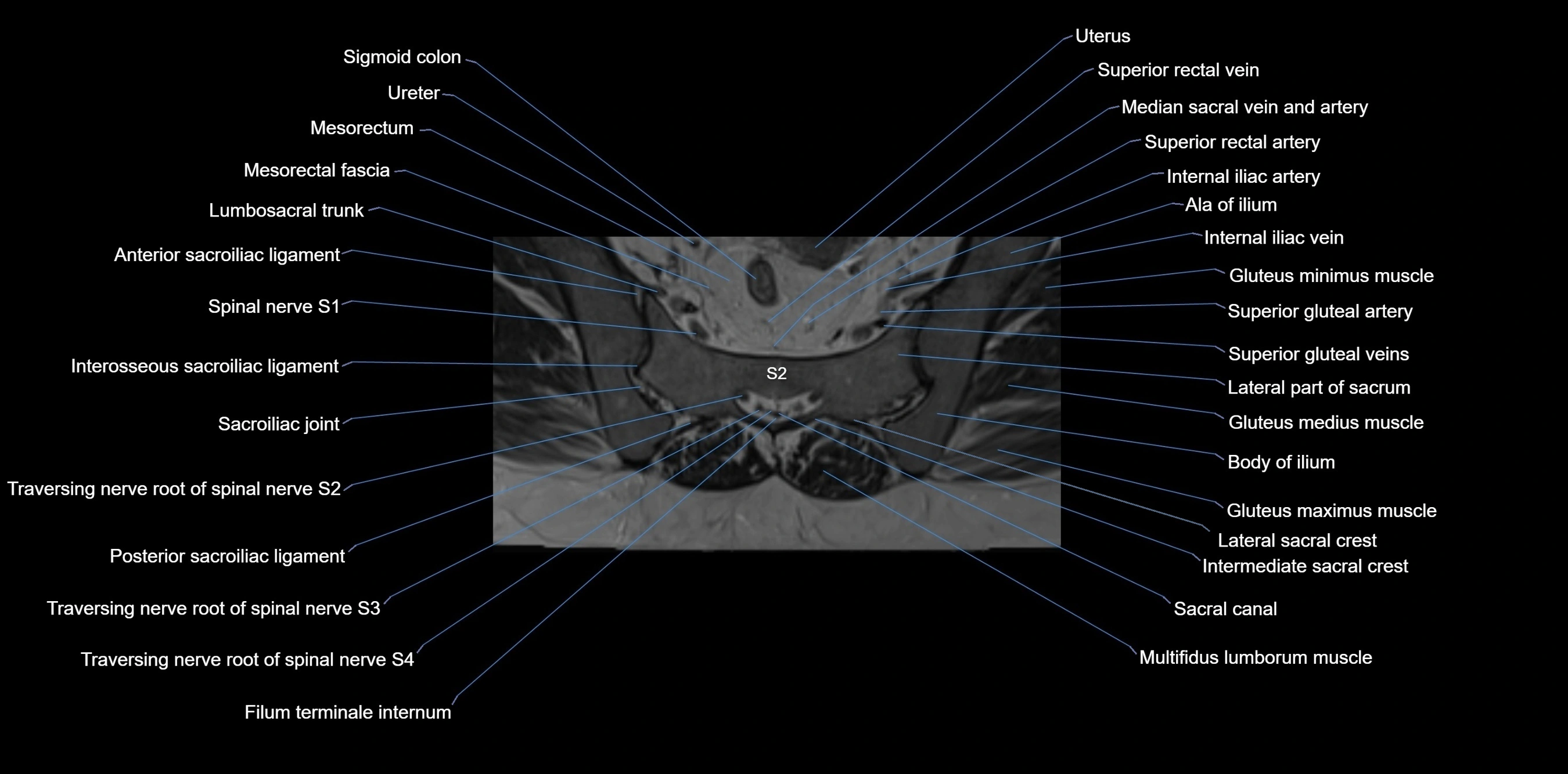 MRI sacrum, coccyx and sacroiliac joint axial cross sectional anatomy 3T  radiology  image-img-00001-00027.webp